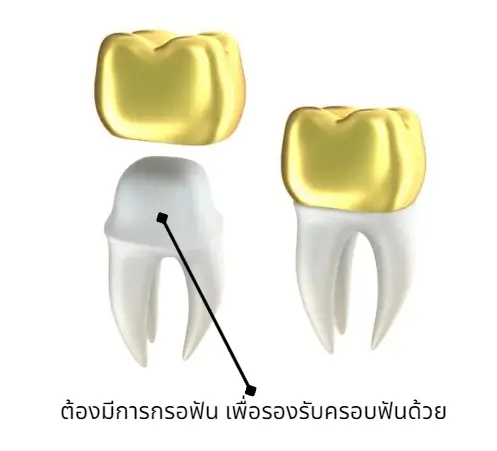 \u0e04\u0e23\u0e2d\u0e1a\u0e1f\u0e31\u0e19\u0e04\u0e37\u0e2d\u0e2d\u0e30\u0e44\u0e23 \u0e21\u0e35\u0e01\u0e35\u0e48\u0e41\u0e1a\u0e1a \u0e23\u0e32\u0e04\u0e32\u0e40\u0e17\u0e48\u0e32\u0e44\u0e2b\u0e23\u0e48\u0e1a\u0e49\u0e32\u0e07 - \u0e04\u0e25\u0e34\u0e19\u0e34\u0e01\u0e17\u0e31\u0e19\u0e15\u0e01\u0e23\u0e23\u0e21 MOS Dental Clinic