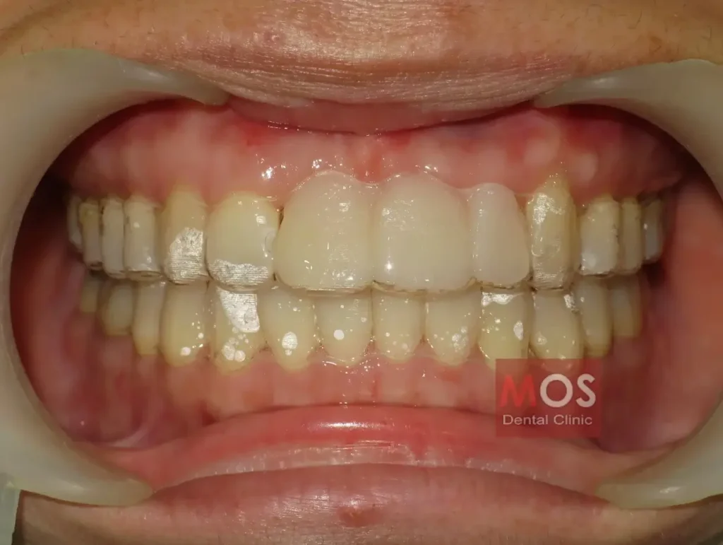 ฟันที่ใส่ invisalign แล้ว