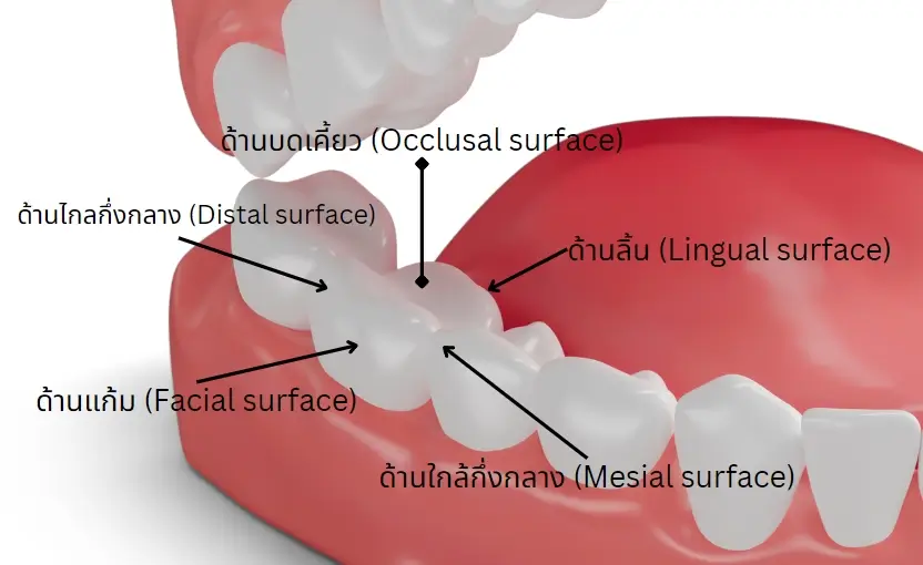 การอุดฟัน 5 ด้านมีอะไรบ้าง