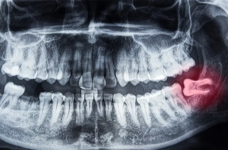 ภาพ x-ray แสดงตำแหน่งฟันคุด