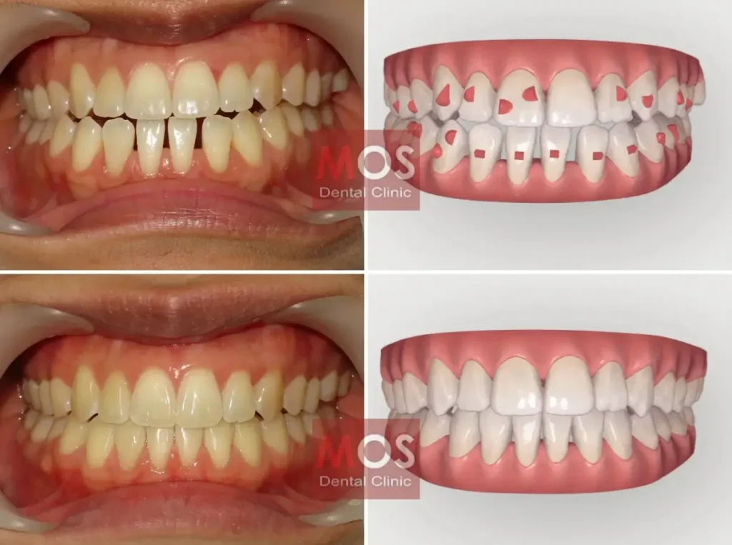 รีวิวจัดฟันใส invisalign เคสที่ 2
