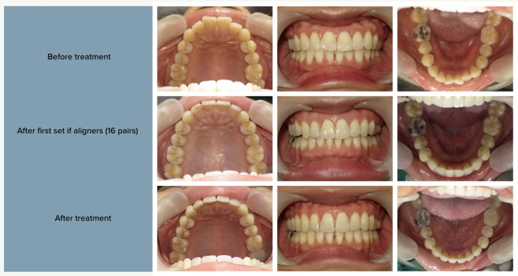 รีวิวจัดฟันใส invisalign