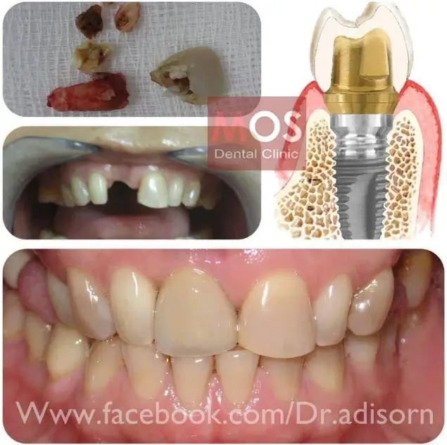 รีวิวการทำรากฟันเทียม