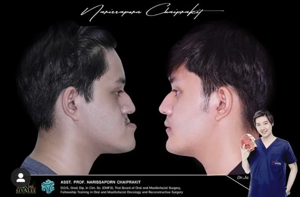 รีวิวผ่าตัดขากรรไกร ก่อน หลัง