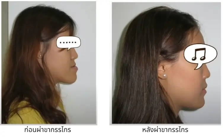 หลังผ่าขากรรไกร ยังไม่ได้จัดฟันขั้นสุดท้าย