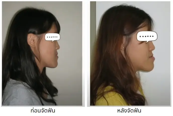 จัดฟันก่อนผ่าตัดขากรรไกร จะทำให้รูปร่างดูแย่ลงชั่วคราว
