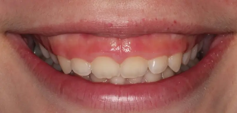 ภาวะเหงือกเยอะ