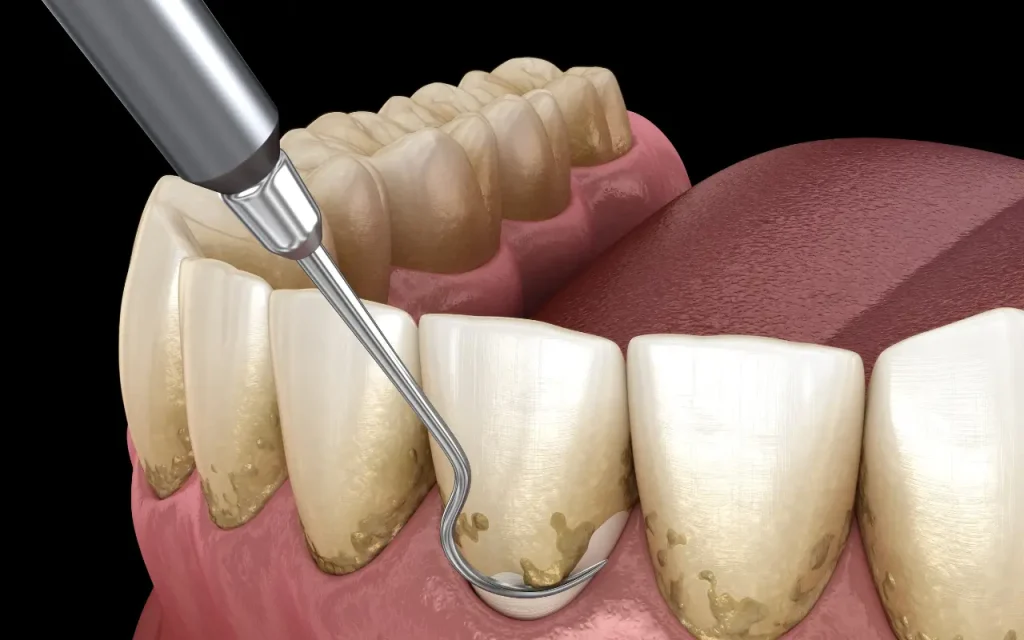 ขูดหินปูนและเกลารากฟัน