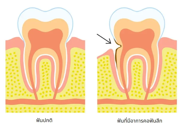 คอฟันสึก เทียบกับฟันธรรมดา
