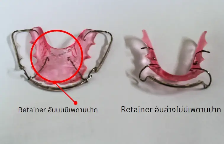 วิธีดูรีเทนเนอร์อันบนอันล่าง