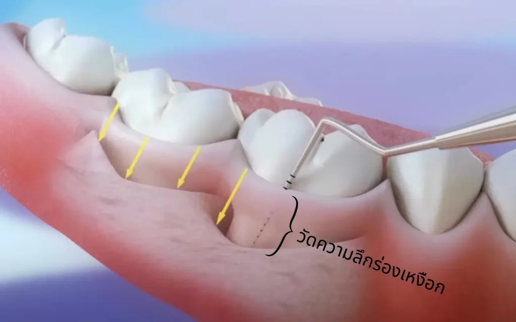 probe วัดความลึกร่องเหงือก
