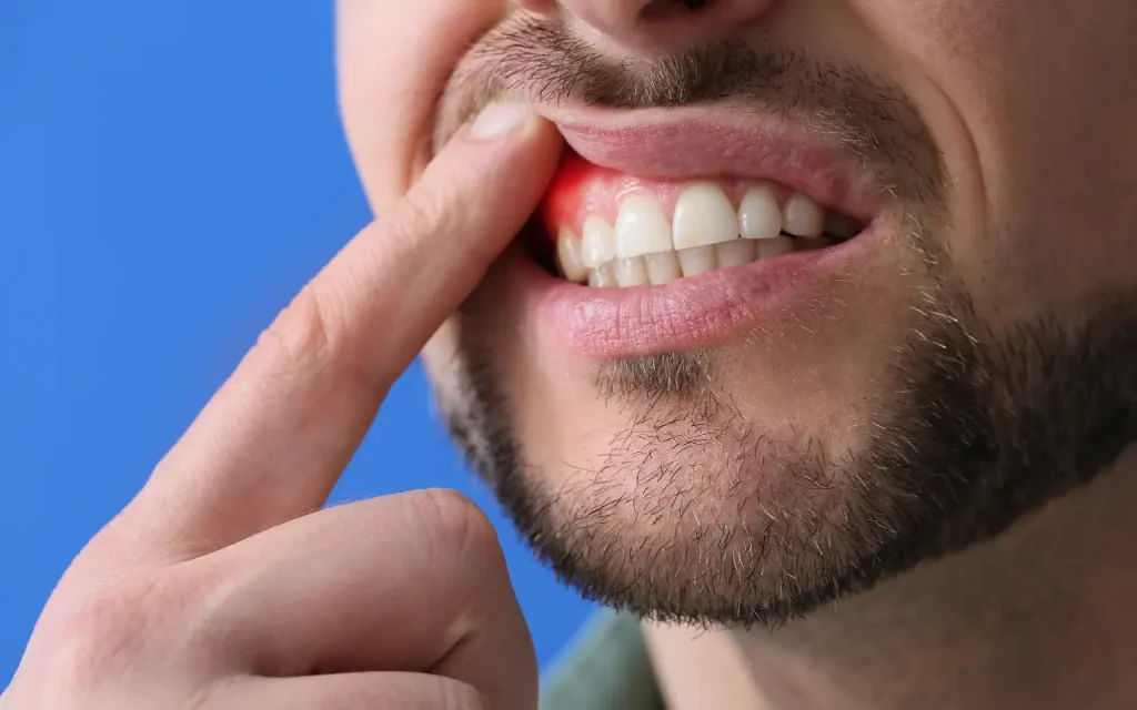 โรคปริทันต์ระยะเริ่มต้น เหงือกบวมแดง