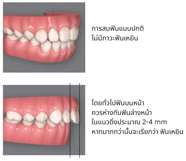 ฟันเหยินคือฟันหน้าบนยื่นออกมากว่าฟันหน้าล่างมากเกิน 4 mm.