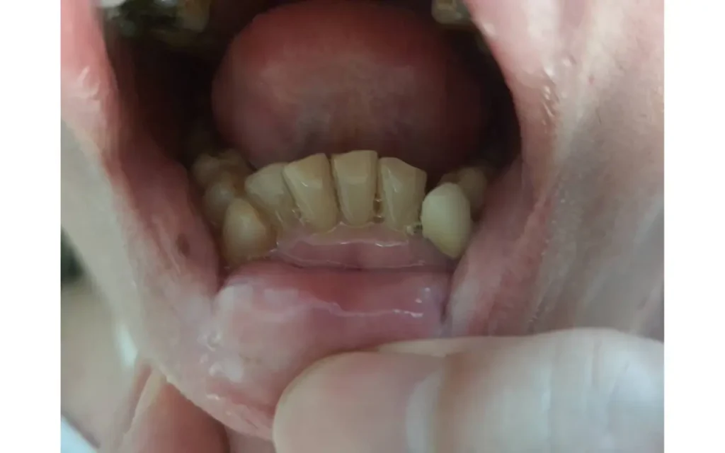 อาการฟันล้ม