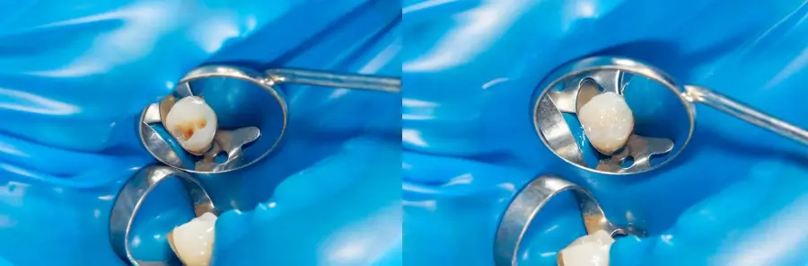 เคลือบหลุมร่องฟัน ก่อน-หลัง