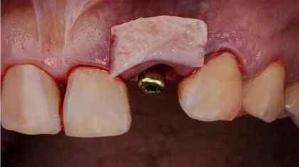 ปลูกเหงือกแบบปลูกถ่ายแผ่นเหงือกอิสระ สำหรับทำรากฟันเทียม