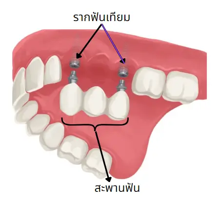 ตัวอย่างการทำรากฟันเทียมร่วมกับสะพานฟัน