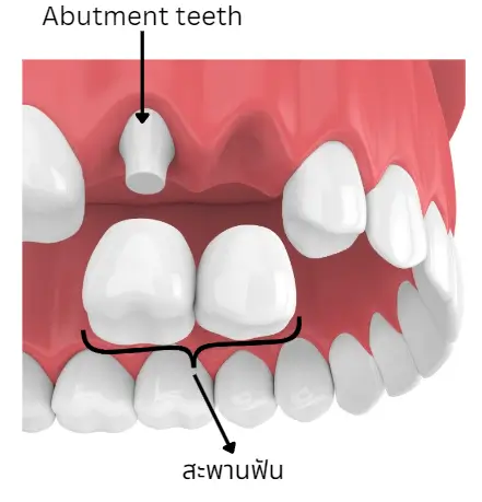 ตัวอย่างการทำสะพานฟัน