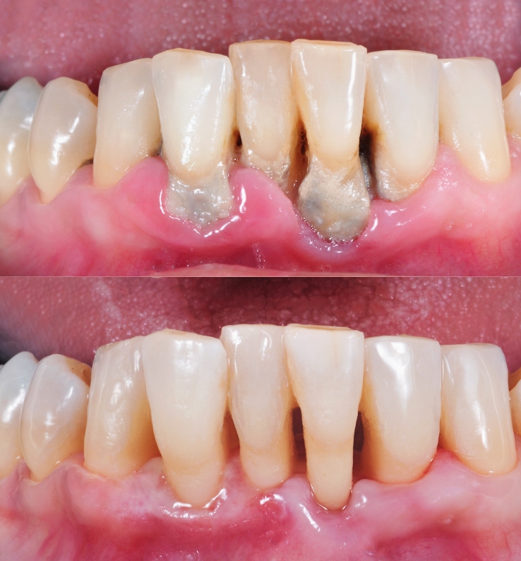 ก่อนและหลังการขูดหินปูน มีอาการเหงือกร่น