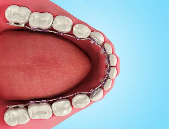 ลิ้นจะสัมผัสเครื่องมือจัดฟันตลอด ทำให้รำคาญ