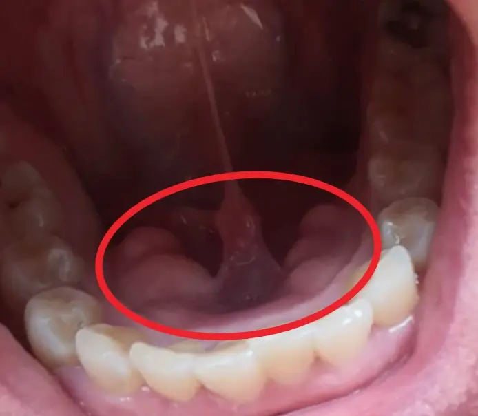 ปุ่มกระดูกในช่องปาก