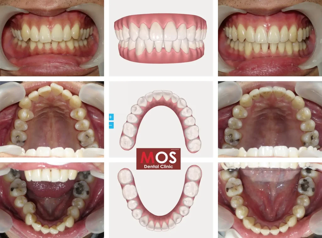 invisalign essential คืออะไร