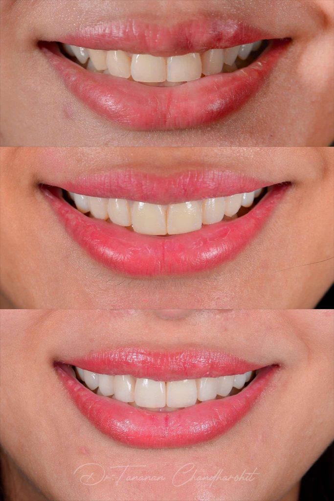 ตัวอย่างเคสวีเนียร์ 3 ธนนันท์ จันทโรหิต 