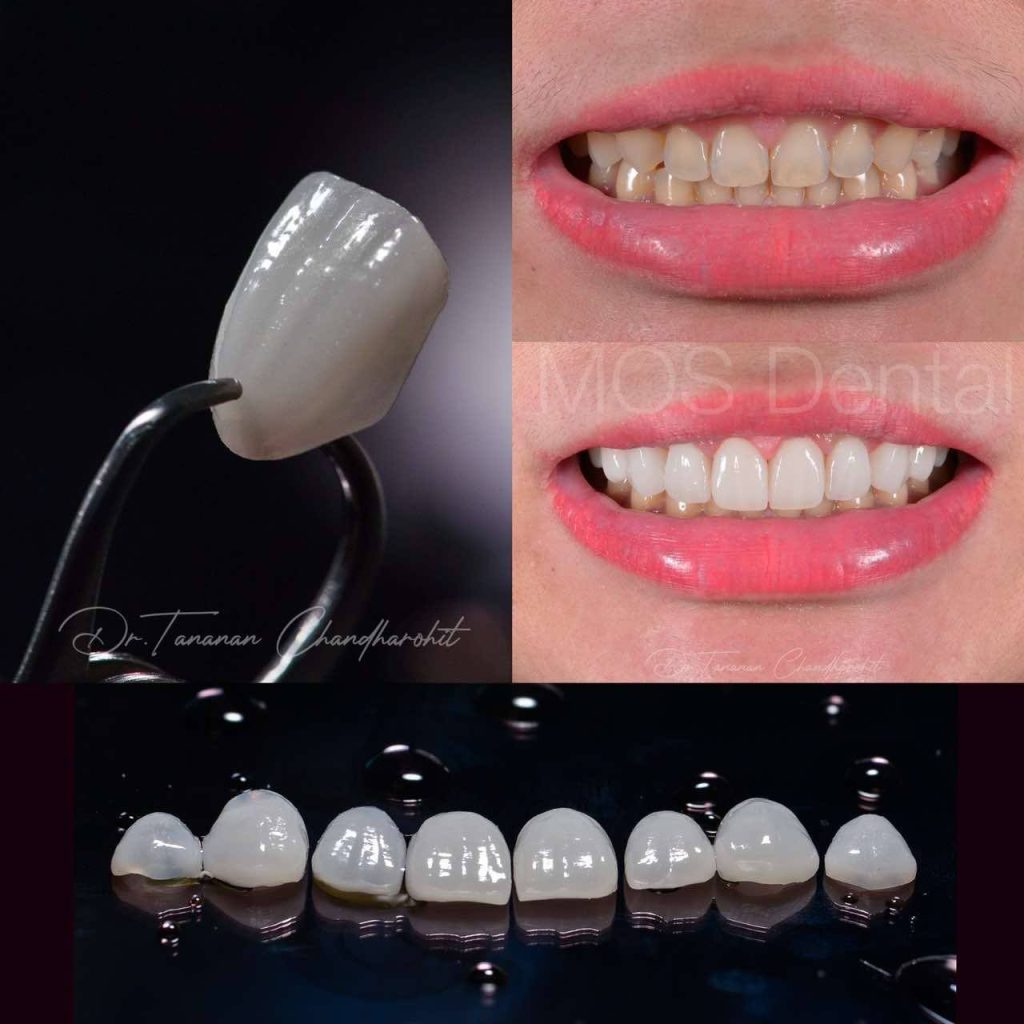 ตัวอย่างเคสวีเนียร์ 2 ธนนันท์ จันทโรหิต 