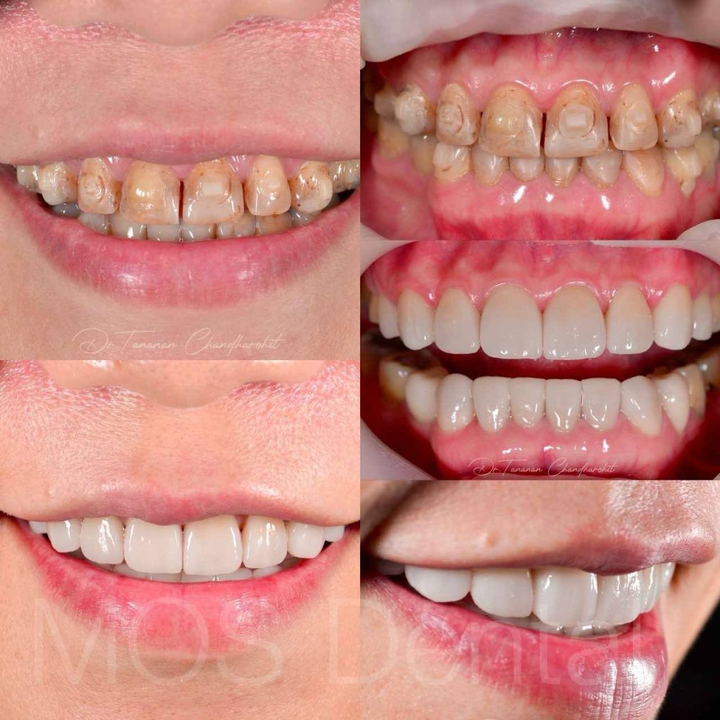 ตัวอย่างเคสวีเนียร์ 4 ธนนันท์ จันทโรหิต 