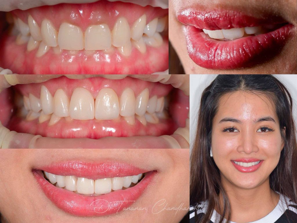 ตัวอย่างเคสวีเนียร์ 5 ธนนันท์ จันทโรหิต 