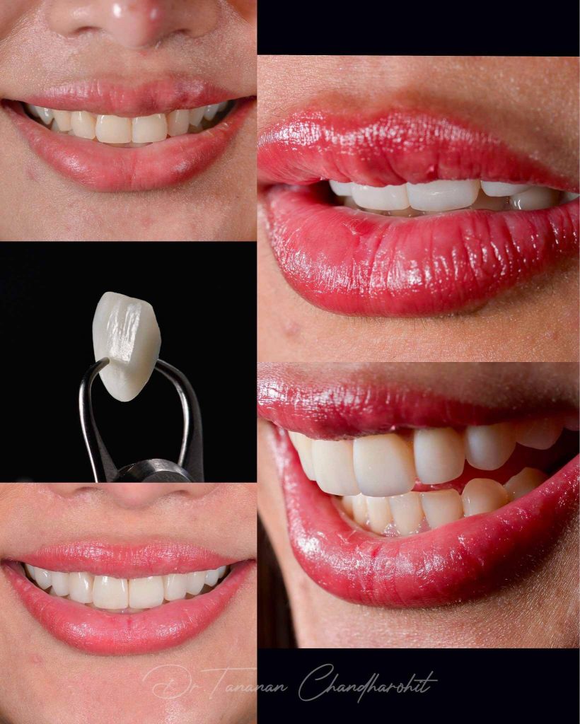 ตัวอย่างเคสวีเนียร์ 1 ธนนันท์ จันทโรหิต 